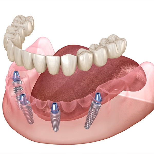 all on 4 dentures