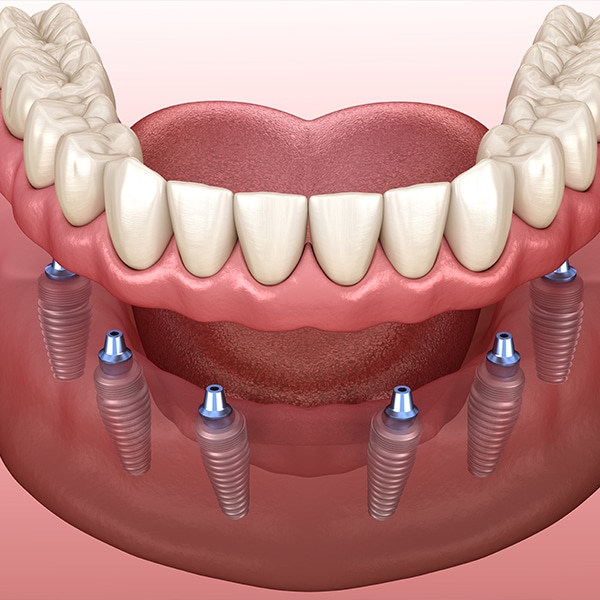 implant denture