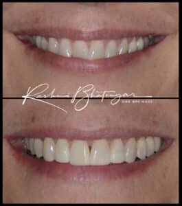 Invisalign before and after by dentique in phoenix az