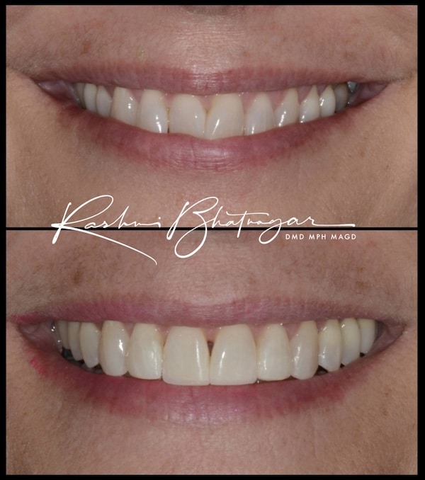 Invisalign