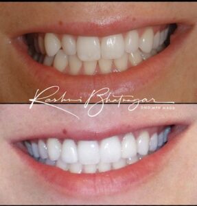veneers