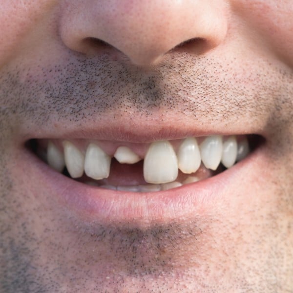 broken teeth