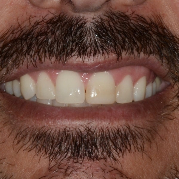 discolored teeth