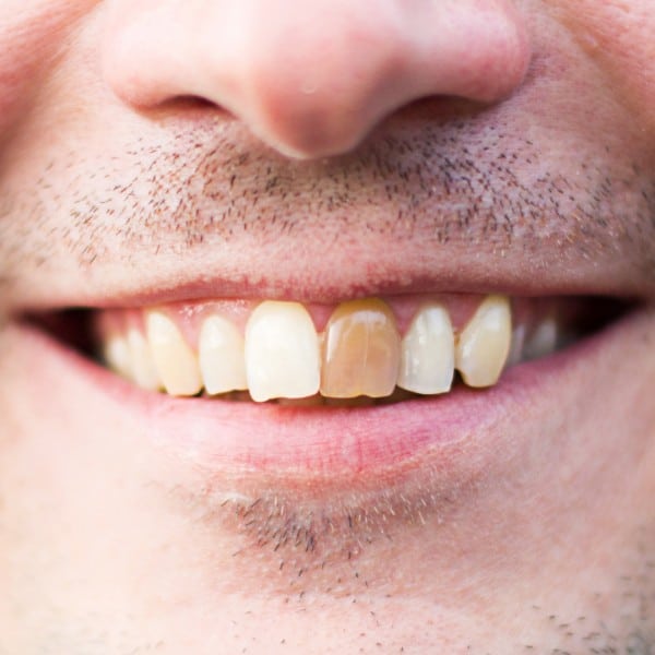 discolored teeth2 1