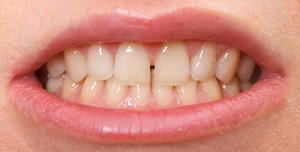 gappy smile new