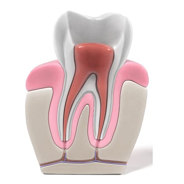 root canal
