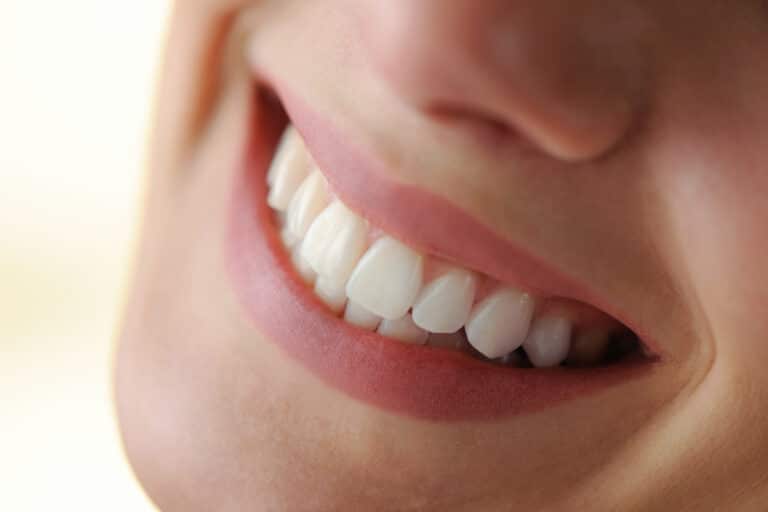 veneers header