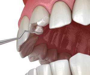 Bioclear Dental Bonding - Chipped Tooth Repair - Dentique Ahwatukee