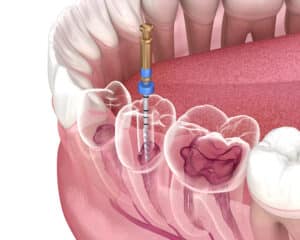Common Misconceptions About Root Canals