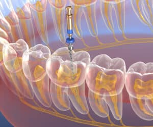 Common Misconceptions About Root Canals