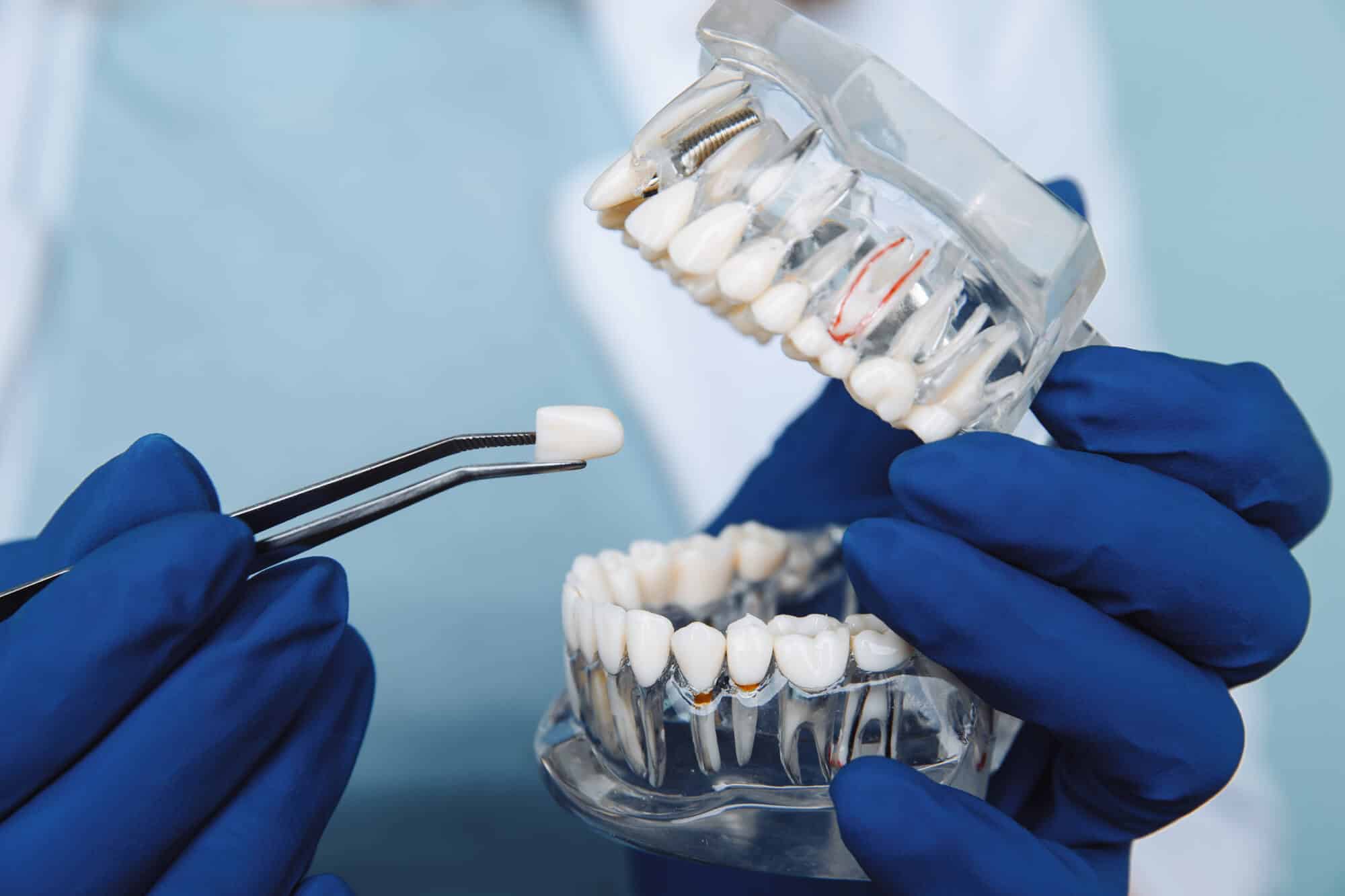 dental implant 1