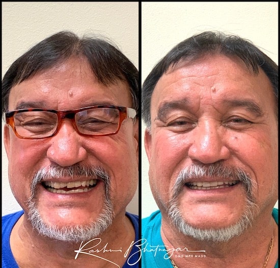 before after