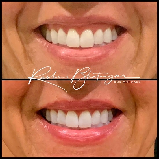 before after