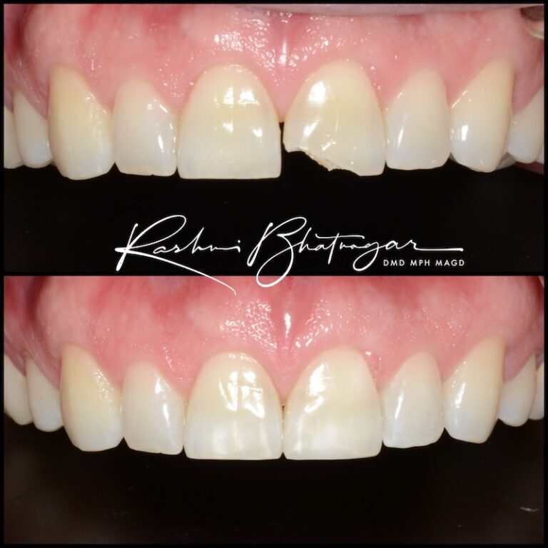 composite bonding 3 800x800