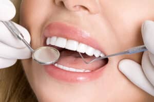 Veneers Seamlessly Match Your Natural Teeth for Realistic Outcomes
