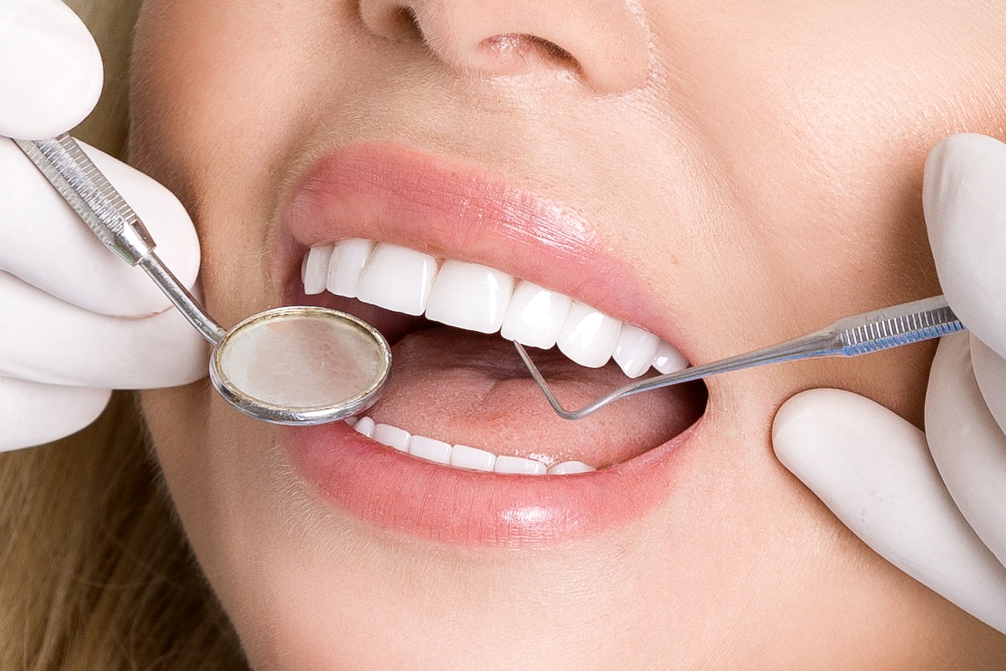 Veneers Seamlessly Match Your Natural Teeth for Realistic Outcomes