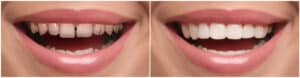 veneer before and after