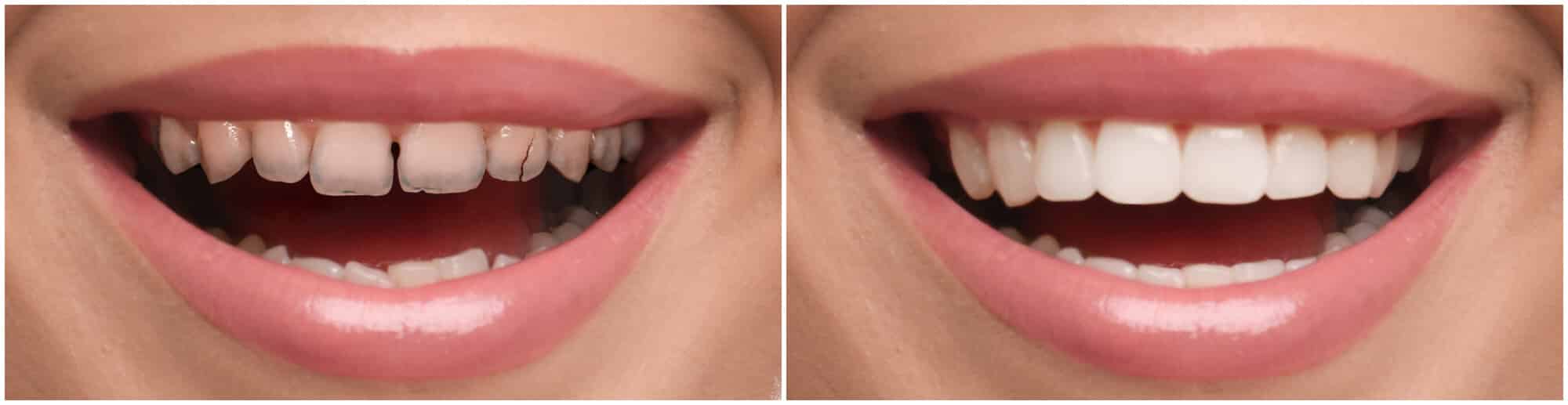 veneers before and after at dentique by dr. b in phoenix, az