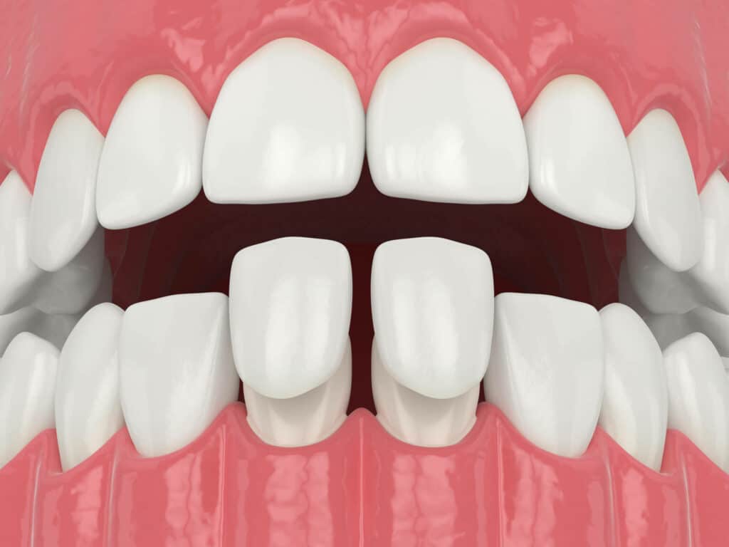 How Veneers Can Improve the Appearance of Your Smile