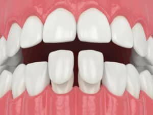 veneer close teeth gaps