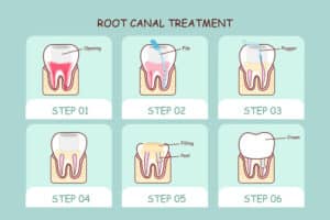 the root canal process