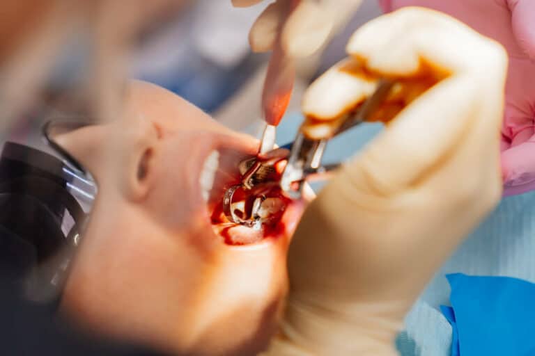 Extraction of Wisdom Teeth Dentique