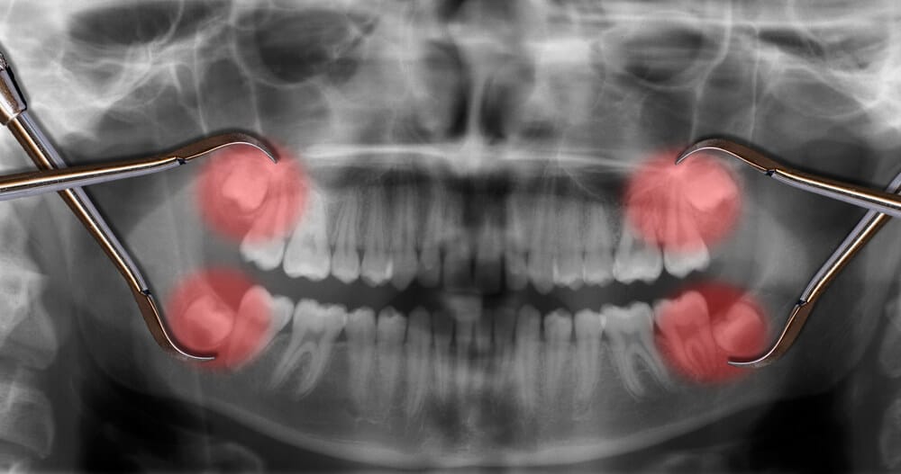 Problems Caused by Wisdom Teeth-Dentique