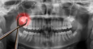 Xray of a wisdom tooth