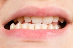 Patient with dislocated jaw and malocclusion, TMD dysfunction.