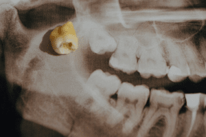 Wisdom Tooth-Dentique