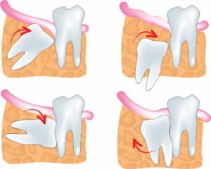 illustration of impacted teeth