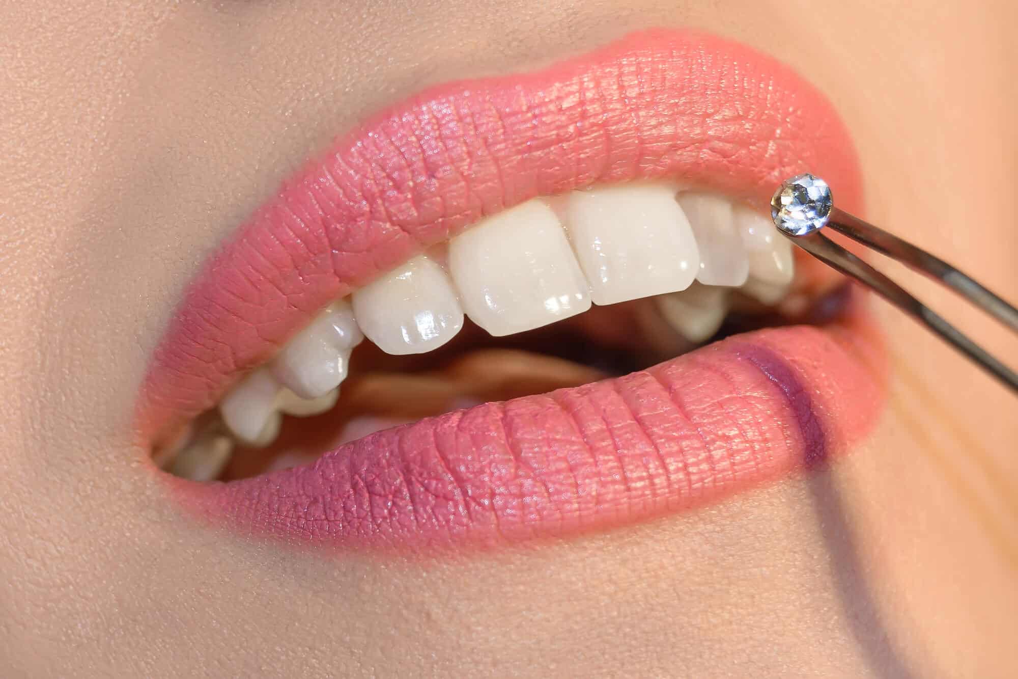 placing tooth gem
