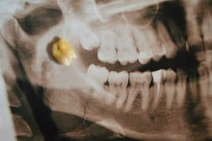 wisdom tooth extraction