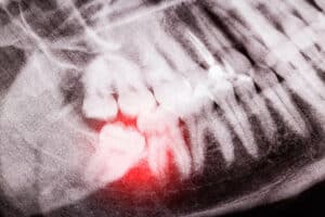 Xray of teeth to be removed