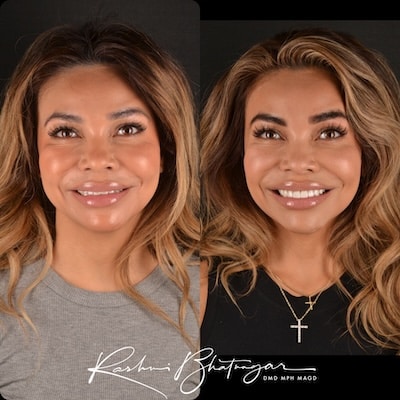 before and after veneers