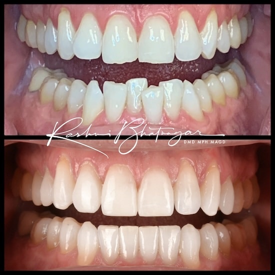 before after