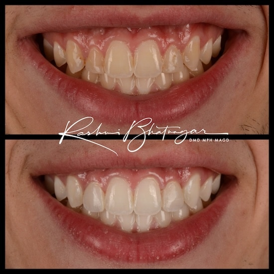 before after