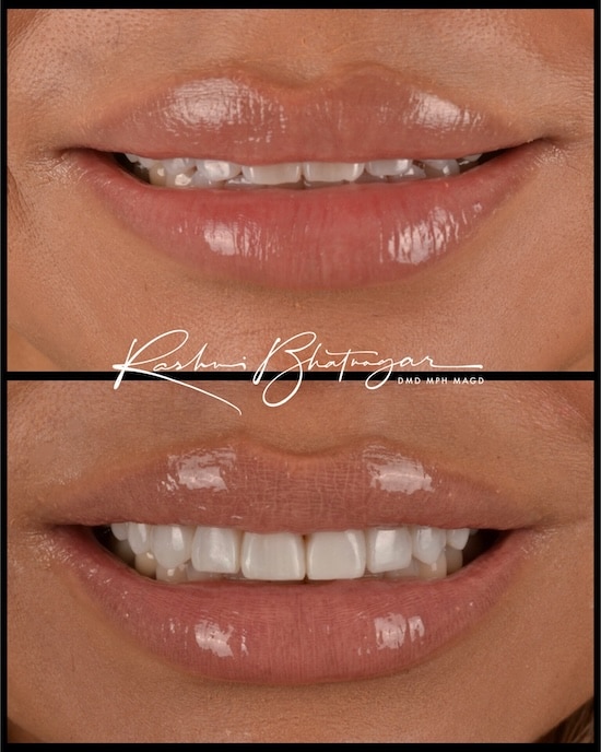 before after