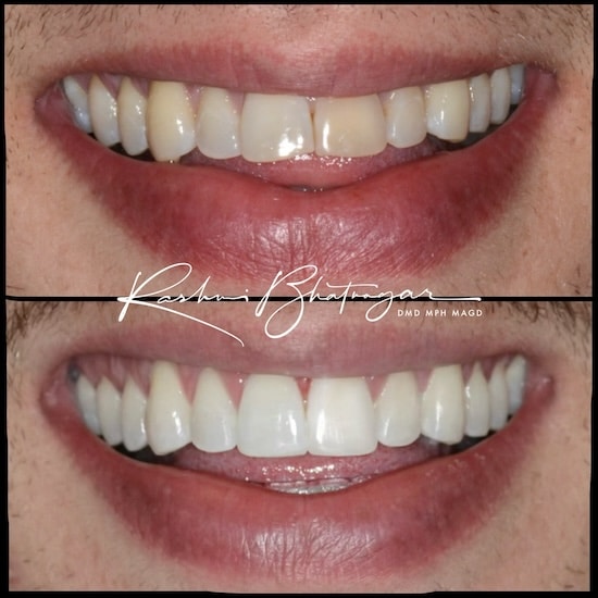 before and after 5 16 3