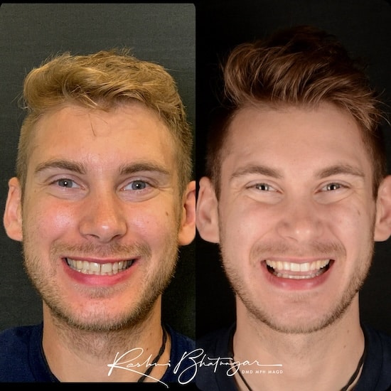 before after
