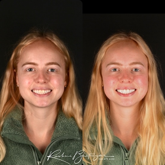 before after