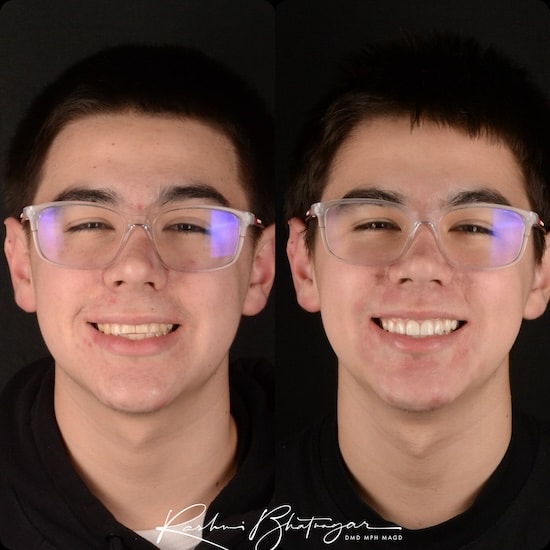 before after