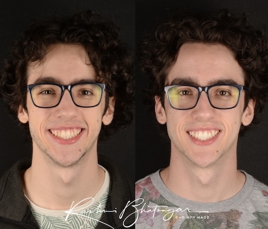 before after