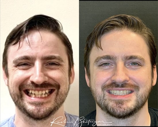 before after