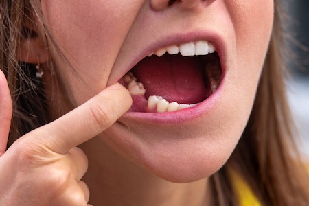 missing tooth