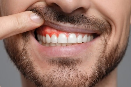 Gum Disease (Gingivitis & Periodontitis): Symptoms, prevention, and treatment