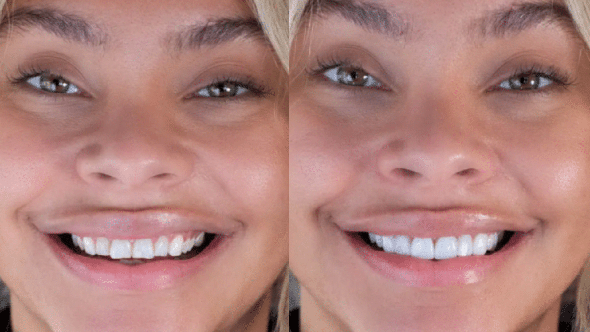 neer veneers in phoenix az